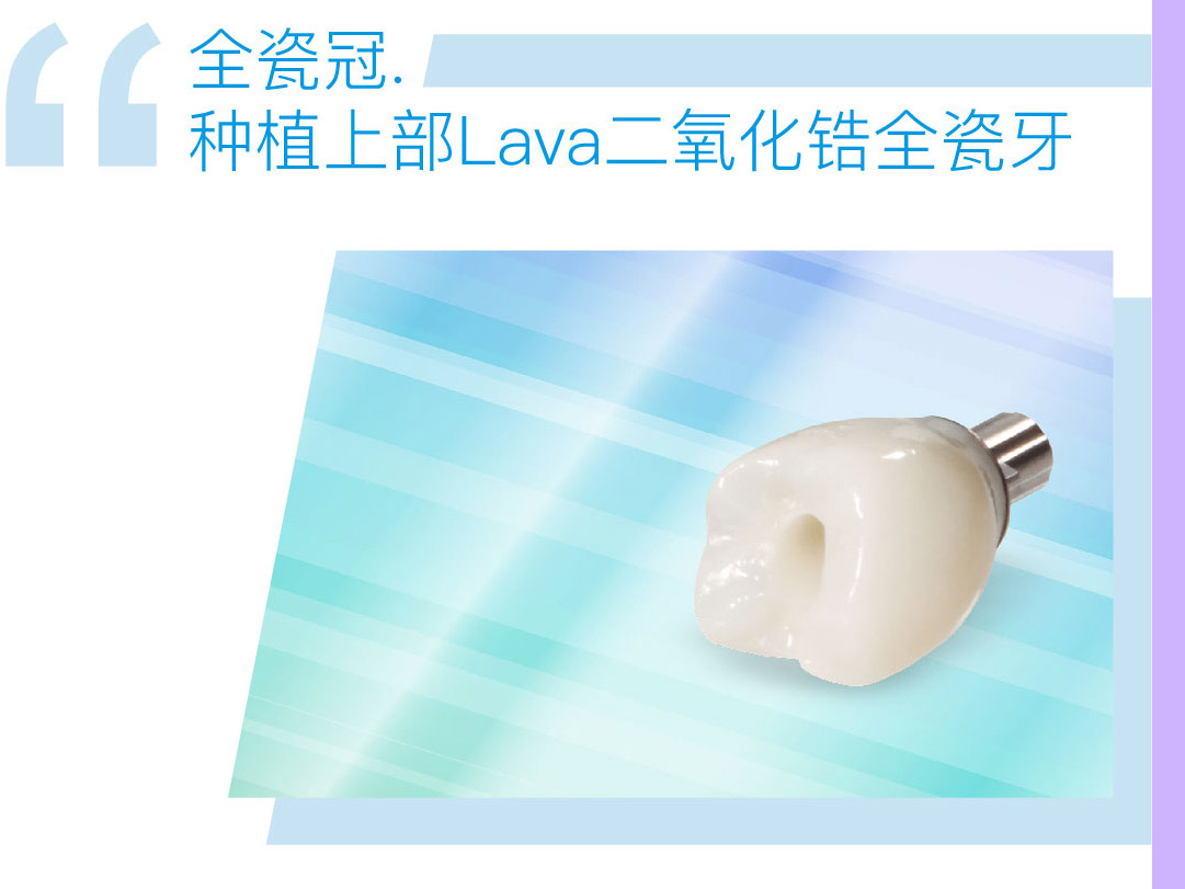 种植上部Lava二氧化锆全瓷牙