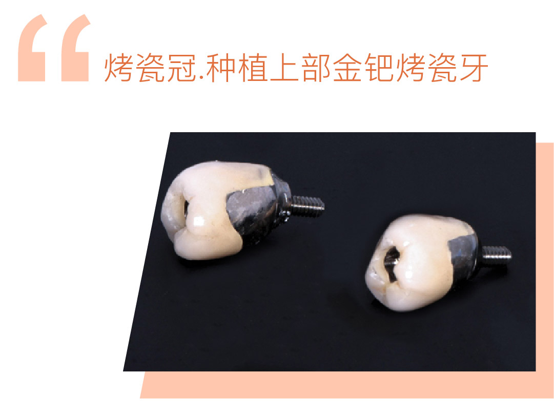 种植上部BIO-HPP聚合瓷牙