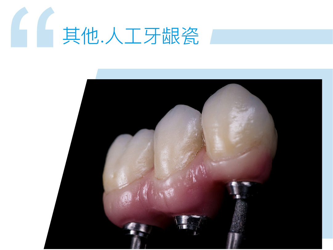人工牙龈瓷