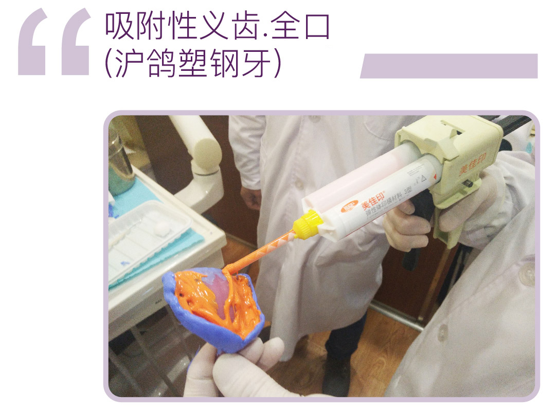 吸附性义齿-全口(沪鸽塑钢牙)