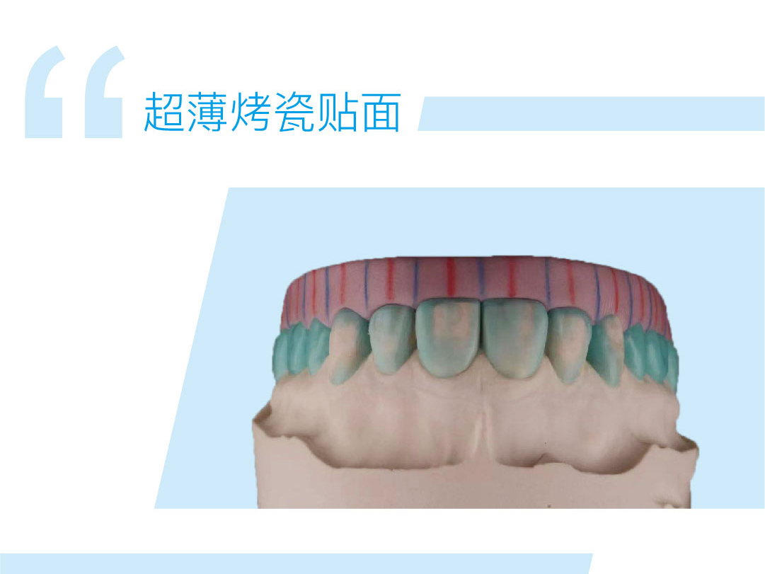 超薄烤瓷贴面