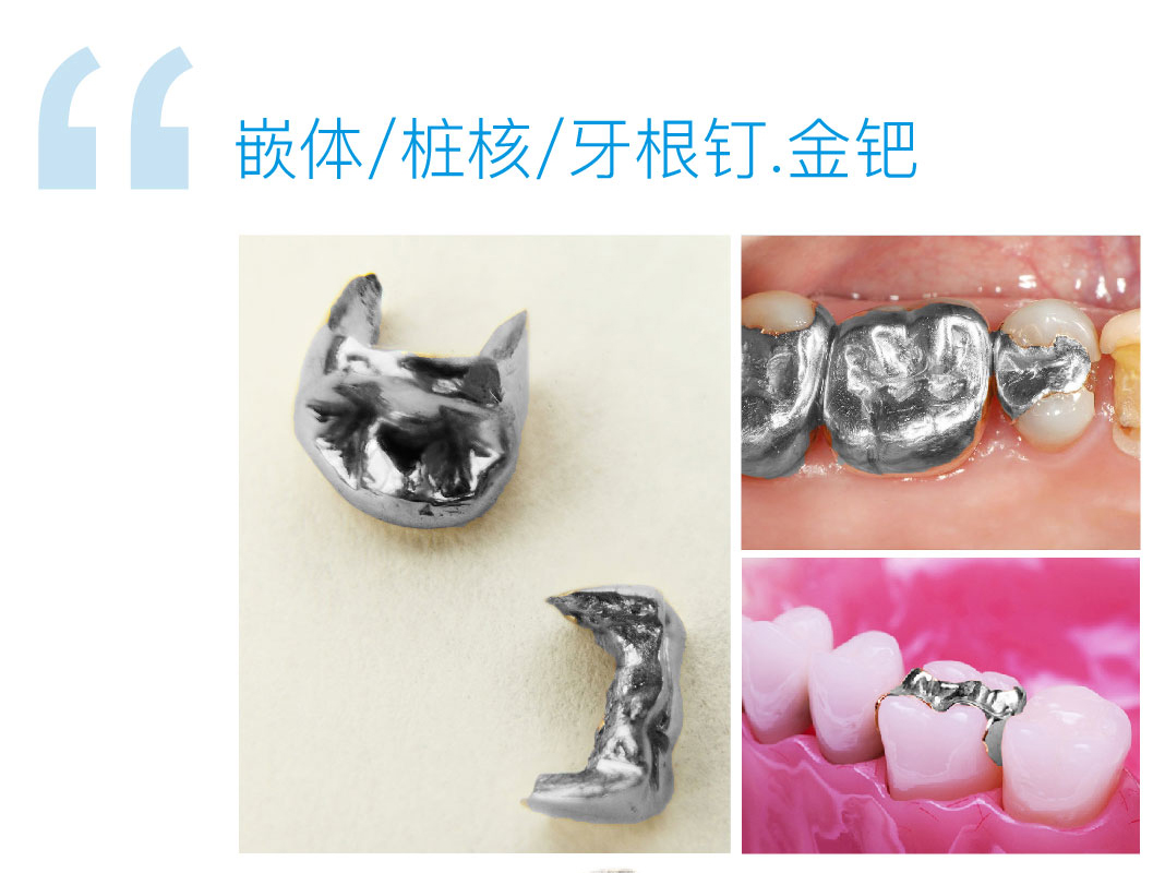 金钯嵌体/桩核/牙根钉
