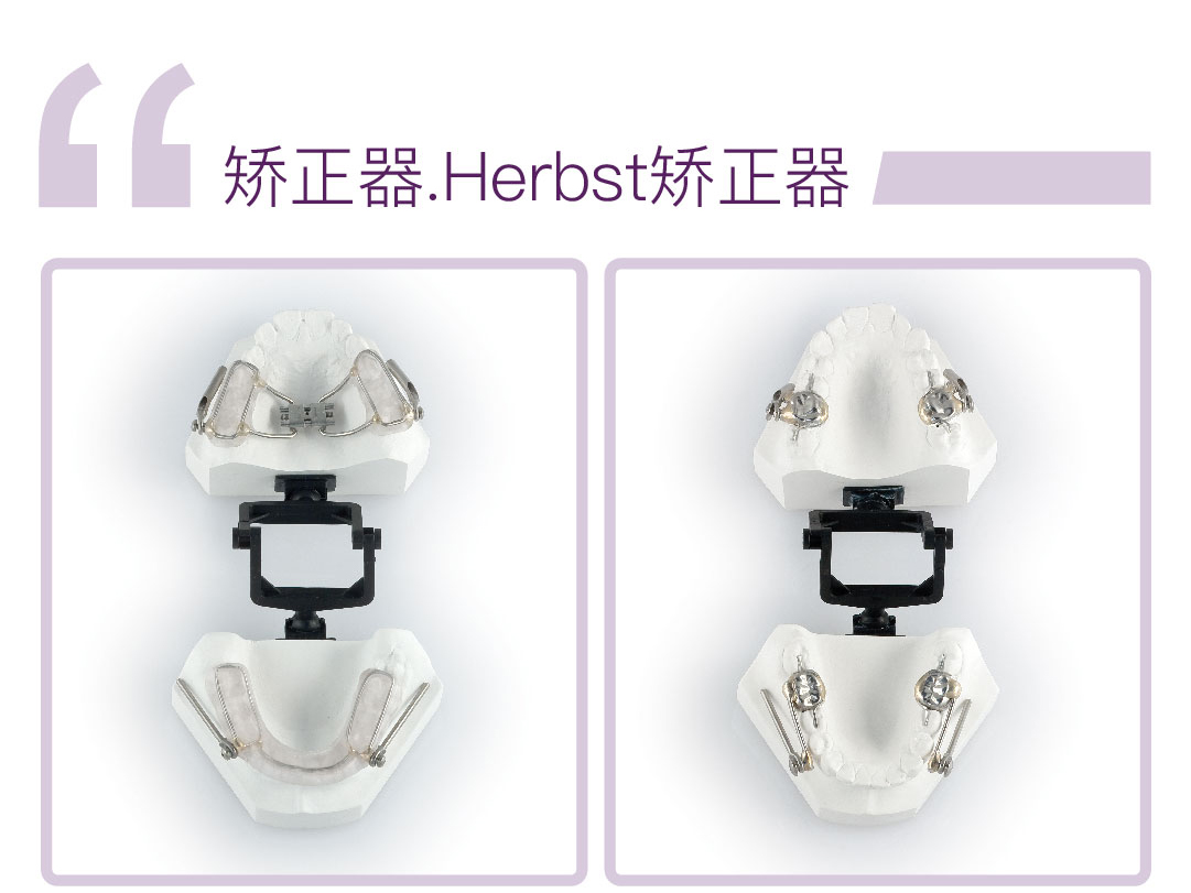 Herbst矫正器