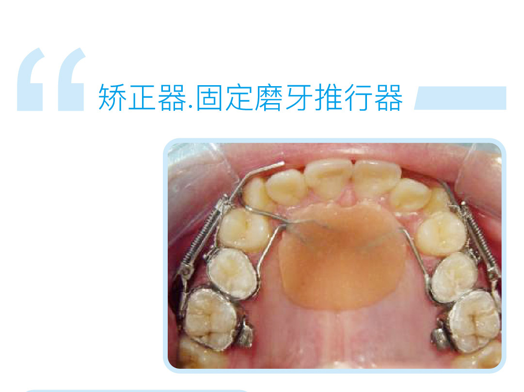 固定磨牙推行器
