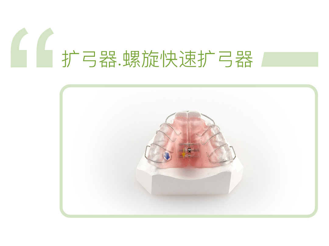 螺旋快速扩弓器