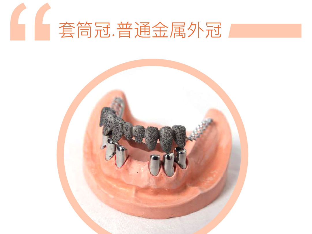 普通金属套筒冠