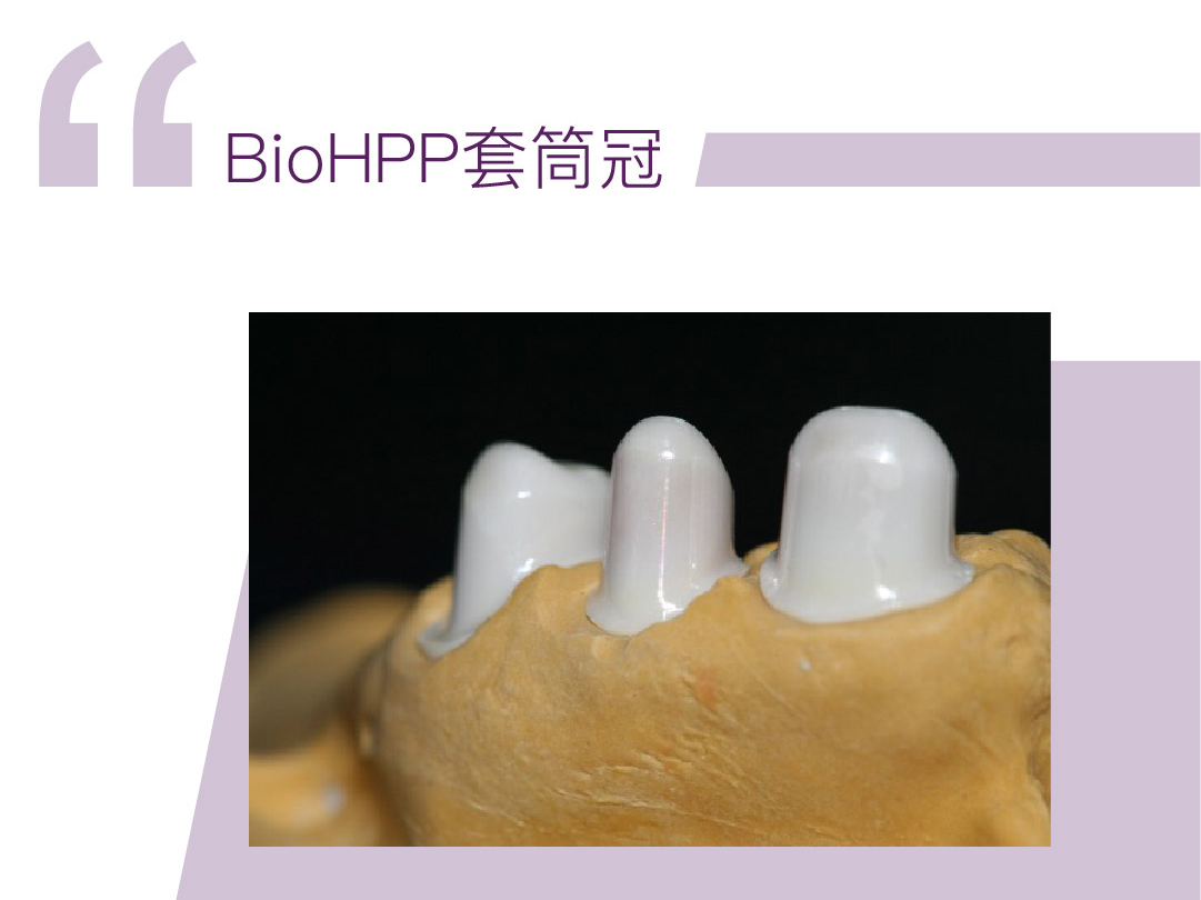 BIO-HPP套筒冠