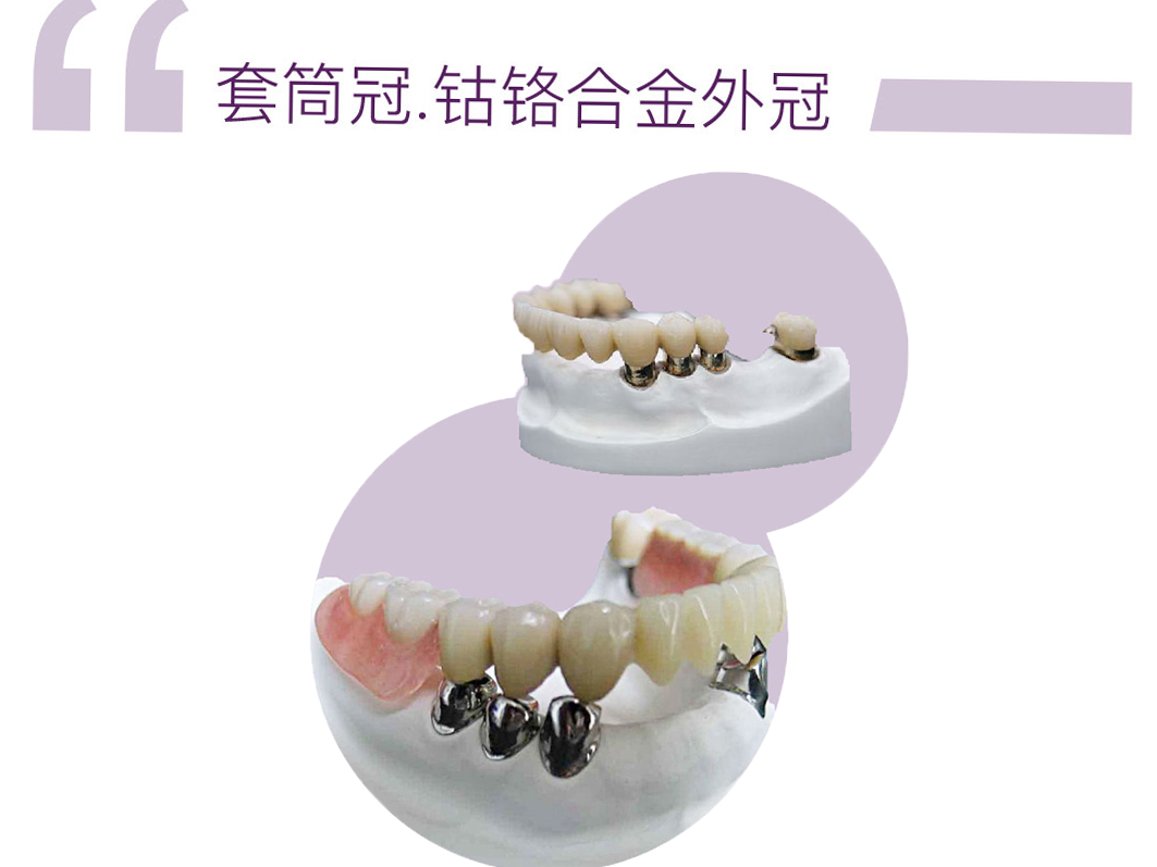 钴铬金属套筒冠