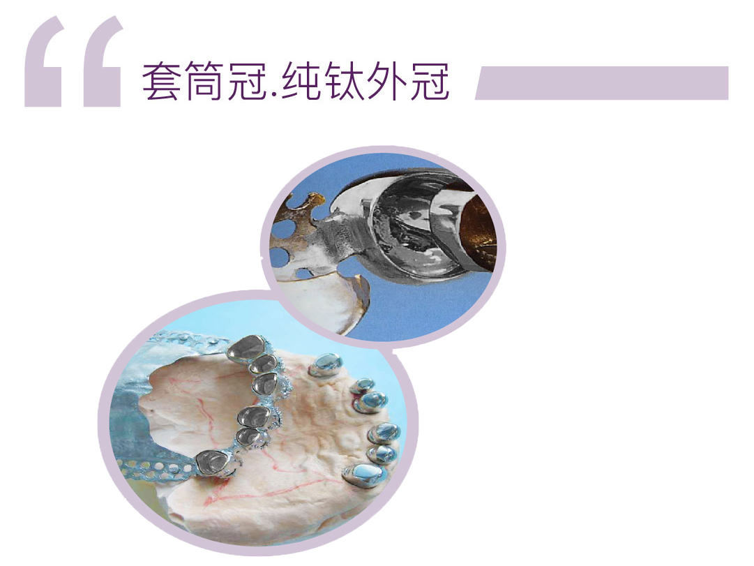 纯钛套筒冠