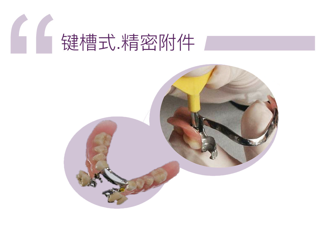 键槽式精密附件