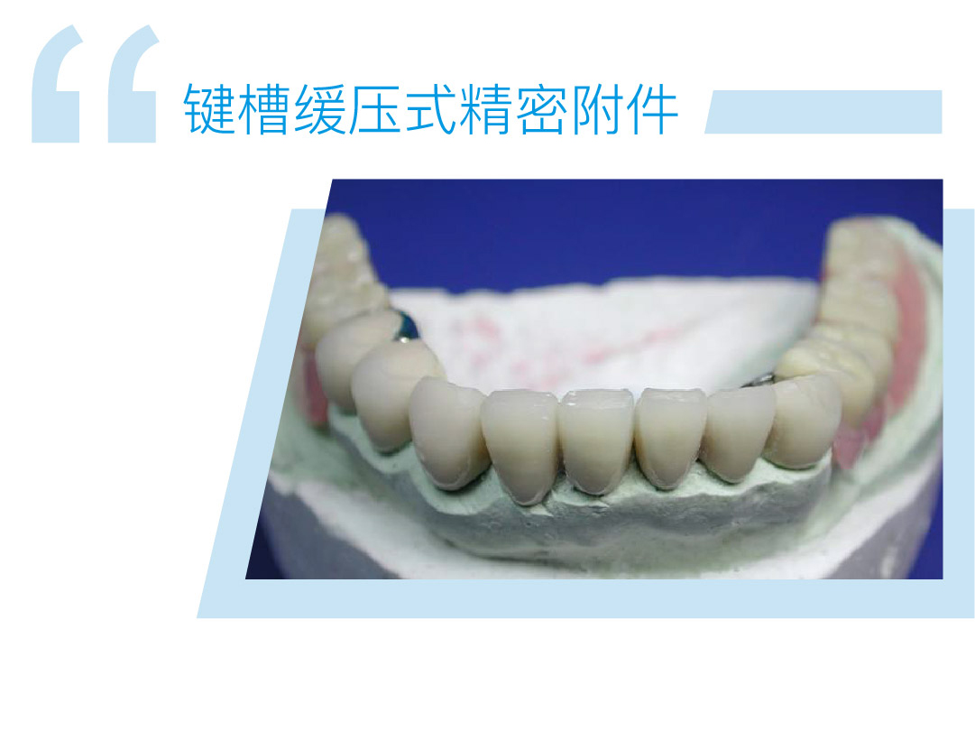 键槽缓压精密附件