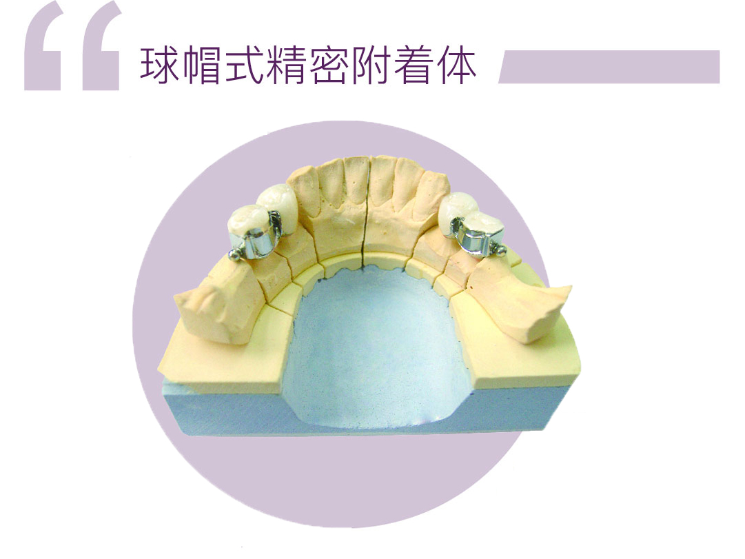 球帽式精密附件（快套式）