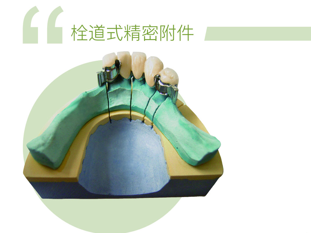 栓道式精密附件