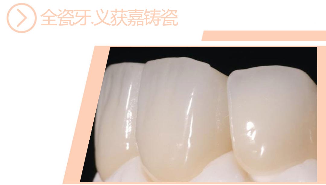 义获嘉铸瓷全瓷牙