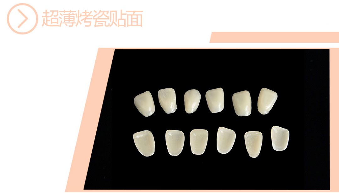 超薄烤瓷贴面