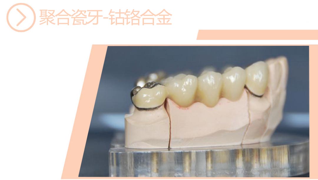 钴铬合金聚合瓷牙