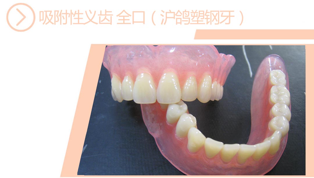 吸附性义齿-全口(沪鸽塑钢牙)