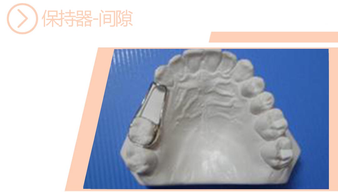 间隙保持器