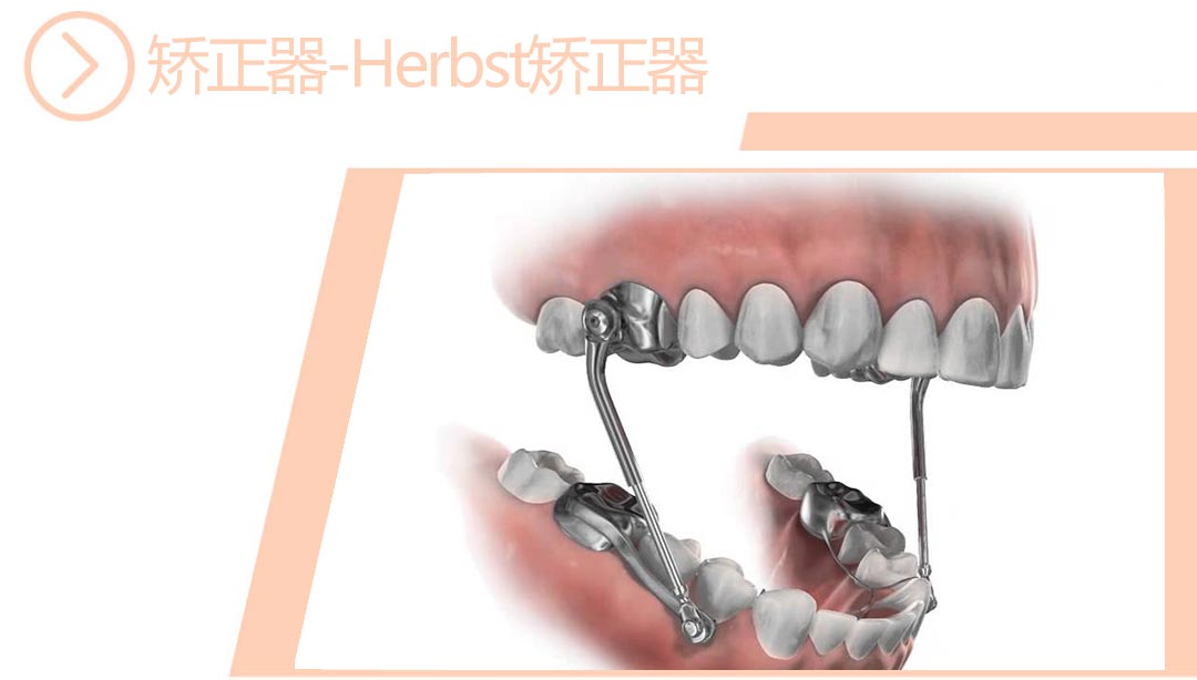 Herbst矫正器