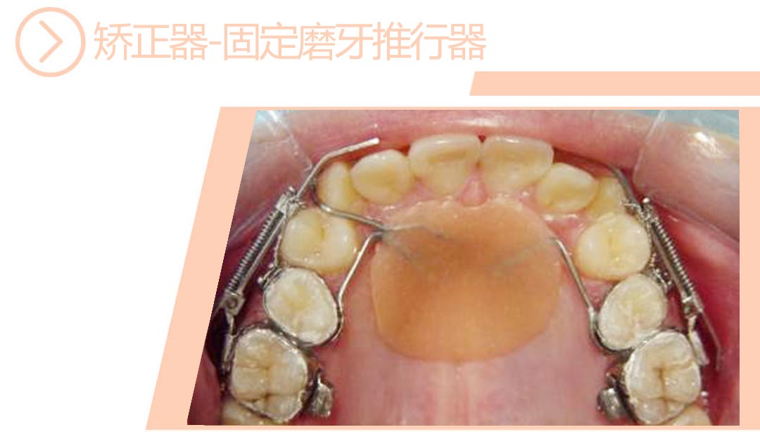 固定磨牙推行器