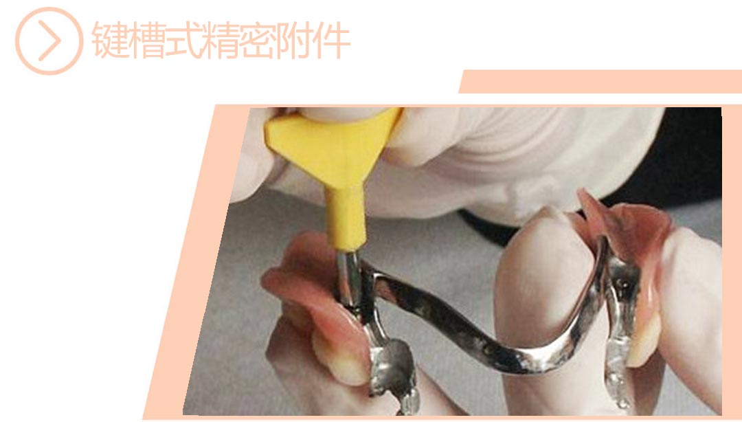 键槽式精密附件