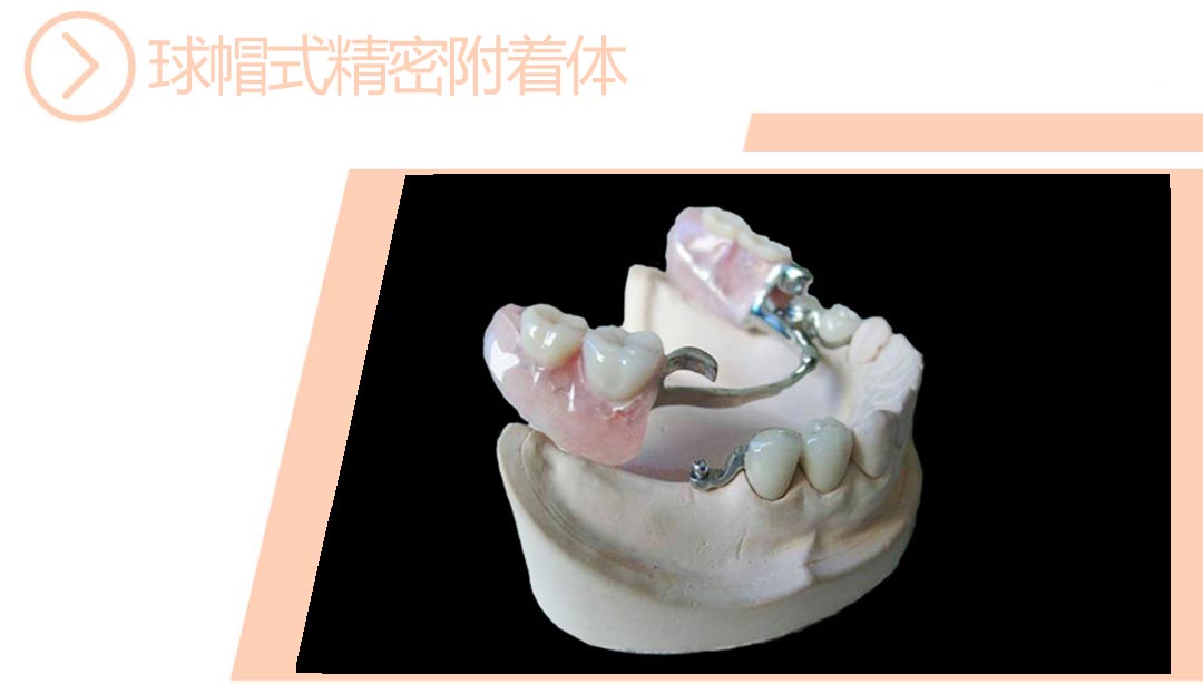 球帽式精密附件（快套式）