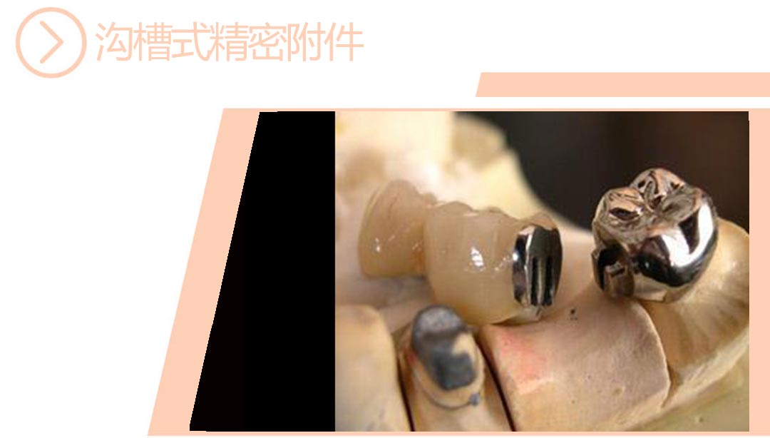 沟槽式精密附件