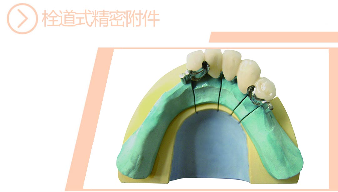 栓道式精密附件