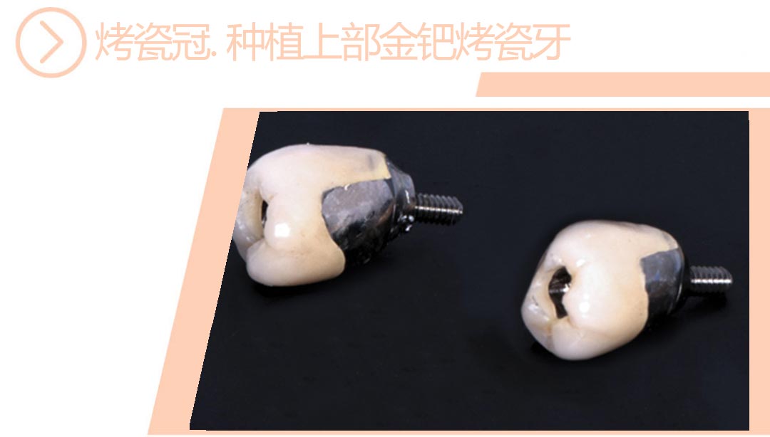 种植上部金钯烤瓷牙