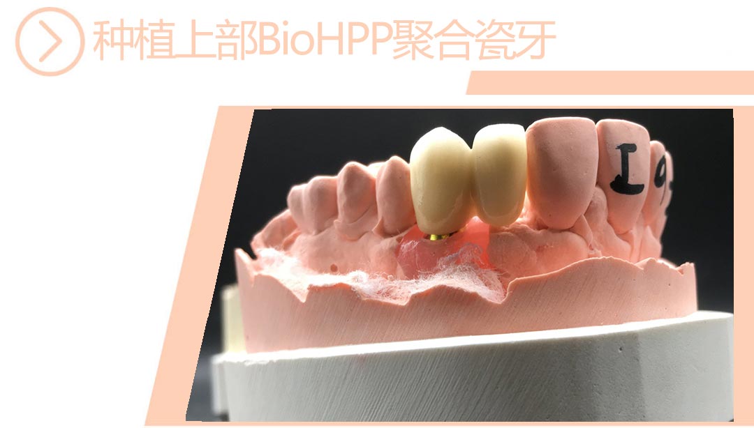 种植上部BIO-HPP聚合瓷牙