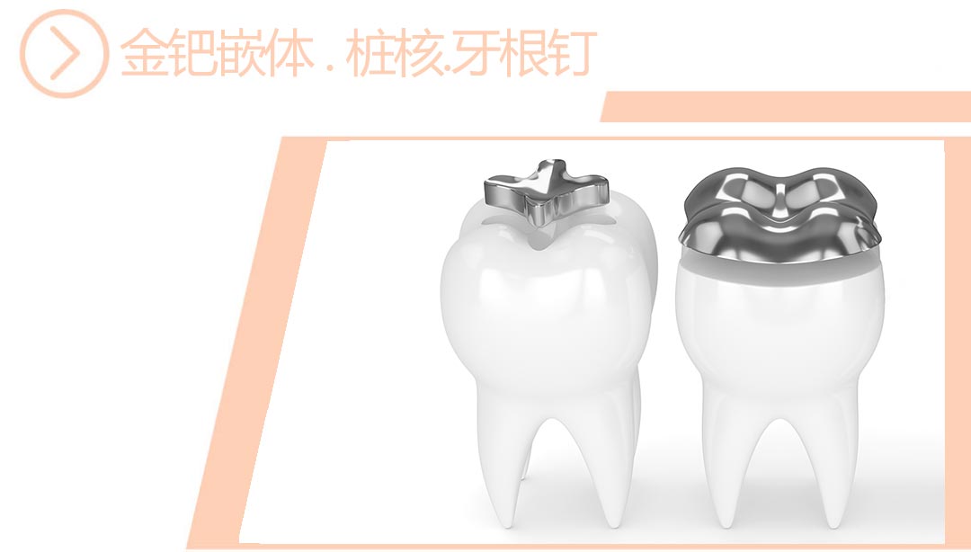 金钯嵌体/桩核/牙根钉