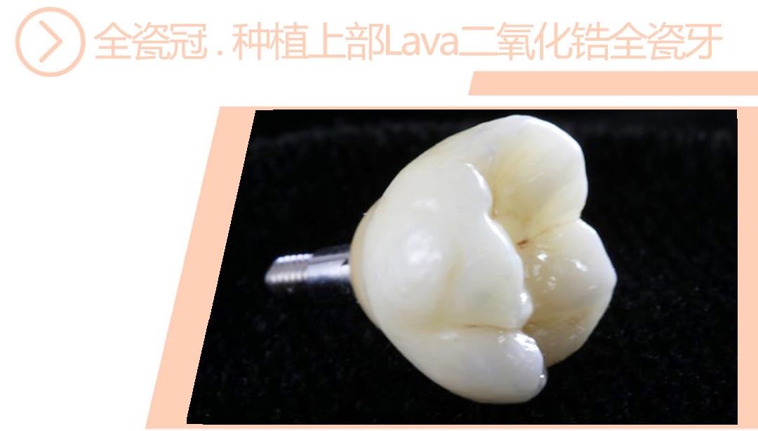 种植上部Lava二氧化锆全瓷牙